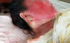 Nghệ An: Mâu thuẫn gia đình, chồng hắt nước sôi vào mặt vợ