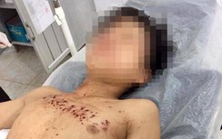 Nam thanh niên bị dập bàn tay vì vừa chơi game vừa sạc điện thoại