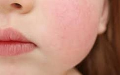 Trẻ sốt phát ban có cần kiêng tắm?