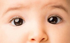 Bác sĩ chuyên khoa mắt cảnh báo trẻ lác mắt, sụp mi dễ nhược thị