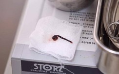 Gắp thành công con vắt dài 5cm ra khỏi mũi bé trai 3 tuổi