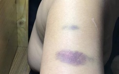 Trường Quốc tế Á Châu nói gì về học sinh lớp 4 bị giáo viên đánh bầm tay?