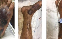 Xuất hiện vi khuẩn "ăn thịt người” độc tố cực cao đến từ biển