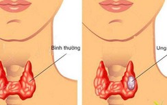 Ung thư tuyến giáp có điều trị dứt điểm được không?