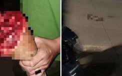 Nhóm thanh thiếu niên hỗn chiến, một người bị chém đứt lìa bàn chân