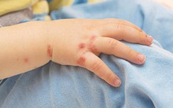 Bệnh chân tay miệng và sốt xuất huyết đang bùng phát ở Lâm Đồng