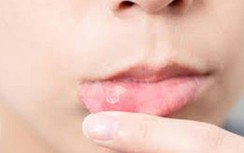 Cần làm gì để giảm nhiệt miệng?