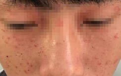 Laptop phát nổ khi đang sạc pin, 3 học sinh nhập viện cấp cứu