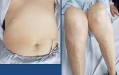 Teo tứ chi, béo bụng, dễ xuất huyết vì lạm dụng corticoid khi chữa bệnh