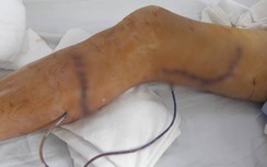 Người đàn ông ở miền Tây bị máy cưa cắt vào đùi, cẳng chân