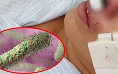 Vùng bão lũ gia tăng bệnh nhân mắc “vi khuẩn ăn thịt người” Withmore