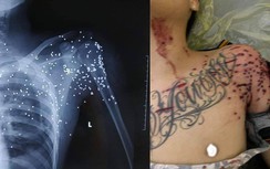 Nóng: Kẻ lạ mặt từ xe khách bắn súng hoa cải khiến nam thanh niên nguy kịch