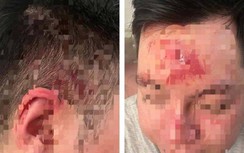 Hà Nội: Mời rượu không uống, nhân viên quán bar vào đánh khách rách trán