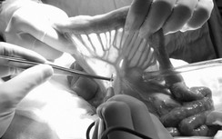 Hy hữu ghép nối ruột non lên họng cho bệnh nhân ung thư thanh quản