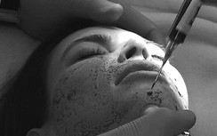 Làm đẹp da bằng “máu tự thân” có an toàn?