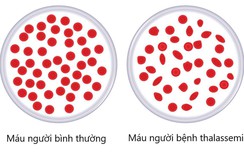 Làm thế nào để phát hiện sớm gene bệnh tan máu bẩm sinh?