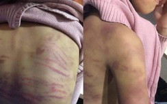 Bé gái Hà Đông nghi bị mẹ đẻ và người tình bạo hành dã man