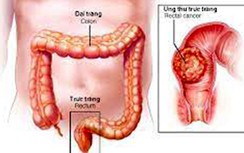Dấu hiệu nào để nhận biết sớm ung thư đại trực tràng?