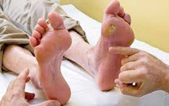 Vì sao các vết viêm loét ở người bệnh tiểu đường chậm lành?