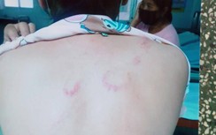 Chồng dùng thắt lưng quật vợ nhập viện