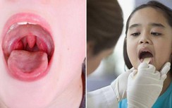 Khi nào trẻ viêm amidan cần phải phẫu thuật?