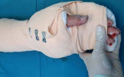 Nối thành công bàn tay bị chém đứt lìa cho nam thanh niên