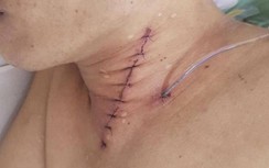 Bệnh nhân nam 42 tuổi suýt chết do hóc xương gà