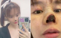 Phẫu thuật thẩm mỹ để hút "vận may" cho chồng, nào ngờ tiền mất tật mang