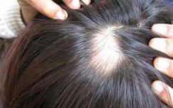 Rụng tóc sau khi khỏi Covid-19, phải làm sao?