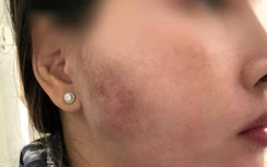 Người phụ nữ 33 tuổi đau nhức, biến dạng mặt sau 1 năm “tiêm má baby”