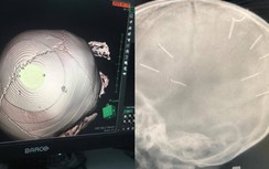 Video: Người nhà cháu bé 3 tuổi bị 9 đinh cắm vào đầu lên tiếng bức xúc