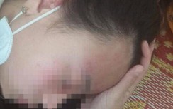 Một nữ sinh lớp 10 bị “chấn động não” do bị hàng xóm hành hung
