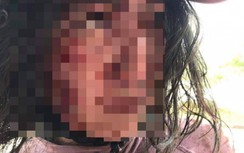 Trên đường đi làm thủ tục ly hôn, người phụ nữ bị chồng hành hung, rạch mặt