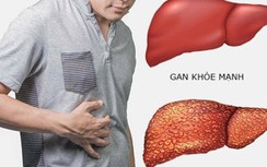 Có thể phát hiện sớm mắc ung thư gan?