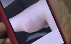 Sau tiêm filler làm thẳng chân, một phụ nữ bị áp xe bắp chân