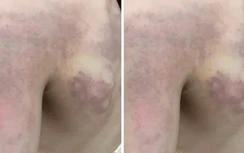 Xác minh vụ giáo viên bị tố đánh học sinh lớp 3 bầm tím vì không thuộc bài