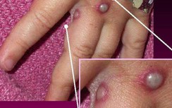 Bệnh đậu mùa khỉ lan rộng ở châu Âu và mới xuất hiện tại Mỹ