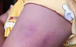 Vụ cô giáo đánh học sinh lớp 1 bầm tím: Chủ tịch huyện chỉ đạo xử lý nghiêm
