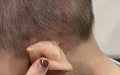 Hải Phòng: Khẩn trương điều tra nghi vấn cháu bé 2 tuổi bị bạo hành