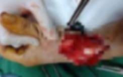 Đang ngủ trên võng trước nhà, bị 5 đối tượng chém chấn thương đầu