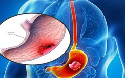 Khi nào nên tầm soát ung thư dạ dày?