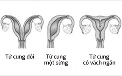 Phụ nữ dị dạng tử cung bẩm sinh cần lưu ý gì?