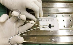 Lấy thành công dị vật lạ "bỗng dưng" rơi vào âm đạo bé gái 8 tuổi