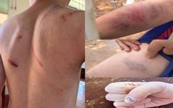 Bố đánh gãy xương, bà nội dùng búa đập ngón tay cháu đối diện tội danh gì?