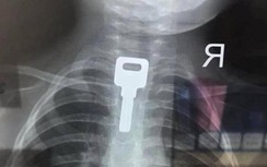 Cấp cứu kịp thời bé trai 2 tuổi bị hóc… chìa khoá