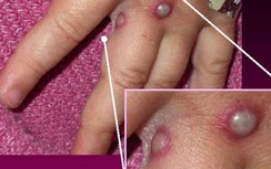 Hôm nay, WHO xem xét đưa ra cảnh báo cao nhất về bệnh đậu mùa khỉ