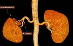 Đau bụng 3 ngày đi khám bất ngờ phát hiện bệnh hiếm gặp ở thận