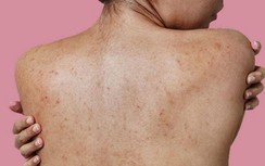 Sau 30 phút bôi thuốc tê trị mụn lưng, một phụ nữ sốc nặng, nhập viện