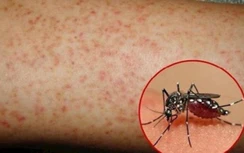 Dịch sốt xuất huyết vào cao điểm, cần lưu ý gì để giảm biến chứng?