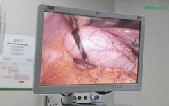 Người phụ nữ phải cắt bỏ túi mật vì “tích” hơn 500 viên sỏi